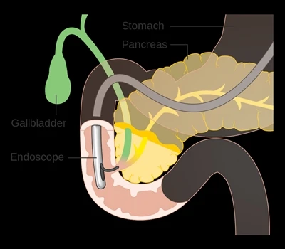 Čo je ERCP a produkty ERCP?