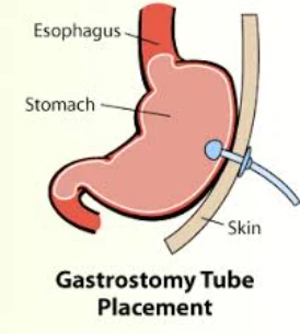Čo je to gastrostomická trubica?